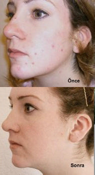 DPL El Terapi Cihazı